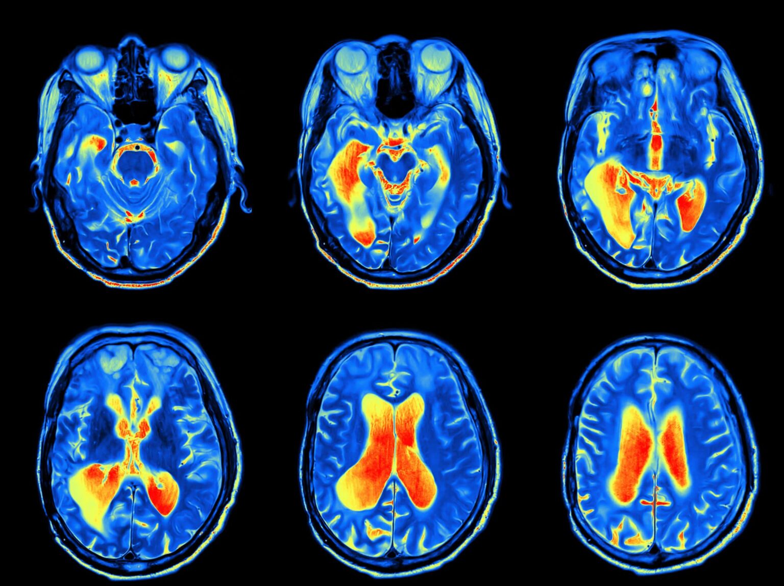 Skull-Base-Tumors-MRI A series of MRI images of the brain during a skull base tumor exam.